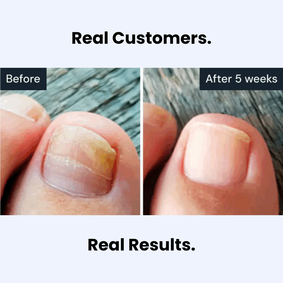 CL™ Antifungal Pen demonstration